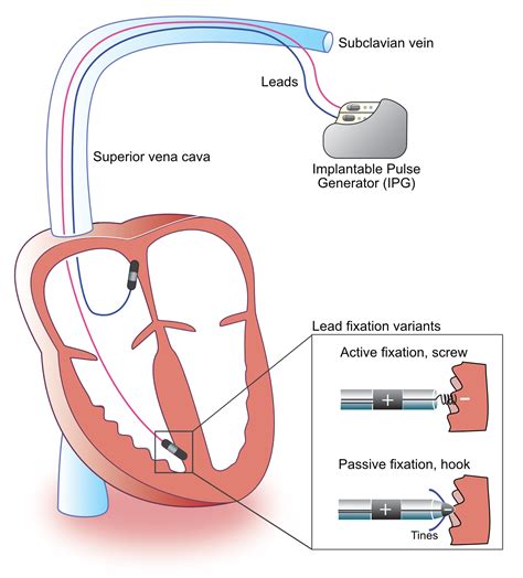 cardiac device interference with pacemaker